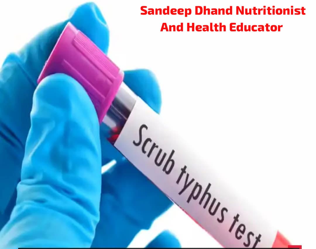 Scrub Typhus: Causes, Symptoms, Treatment, Prevention, and Diet Plan 1 WhatsApp Image 2025 12 10 at 1.48.55 PM